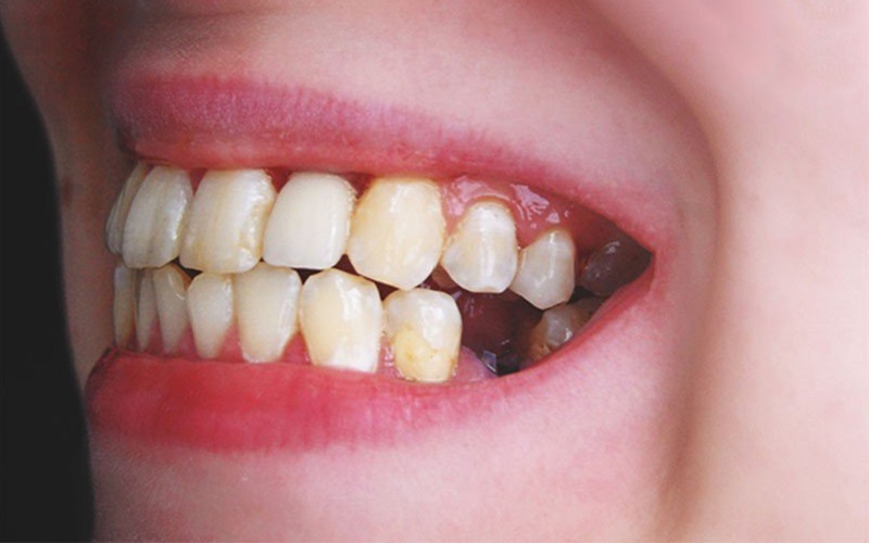 Mộng thấy gãy 1 chiếc răng cho biết sức khỏe bạn và gia đình đang có vấn đề